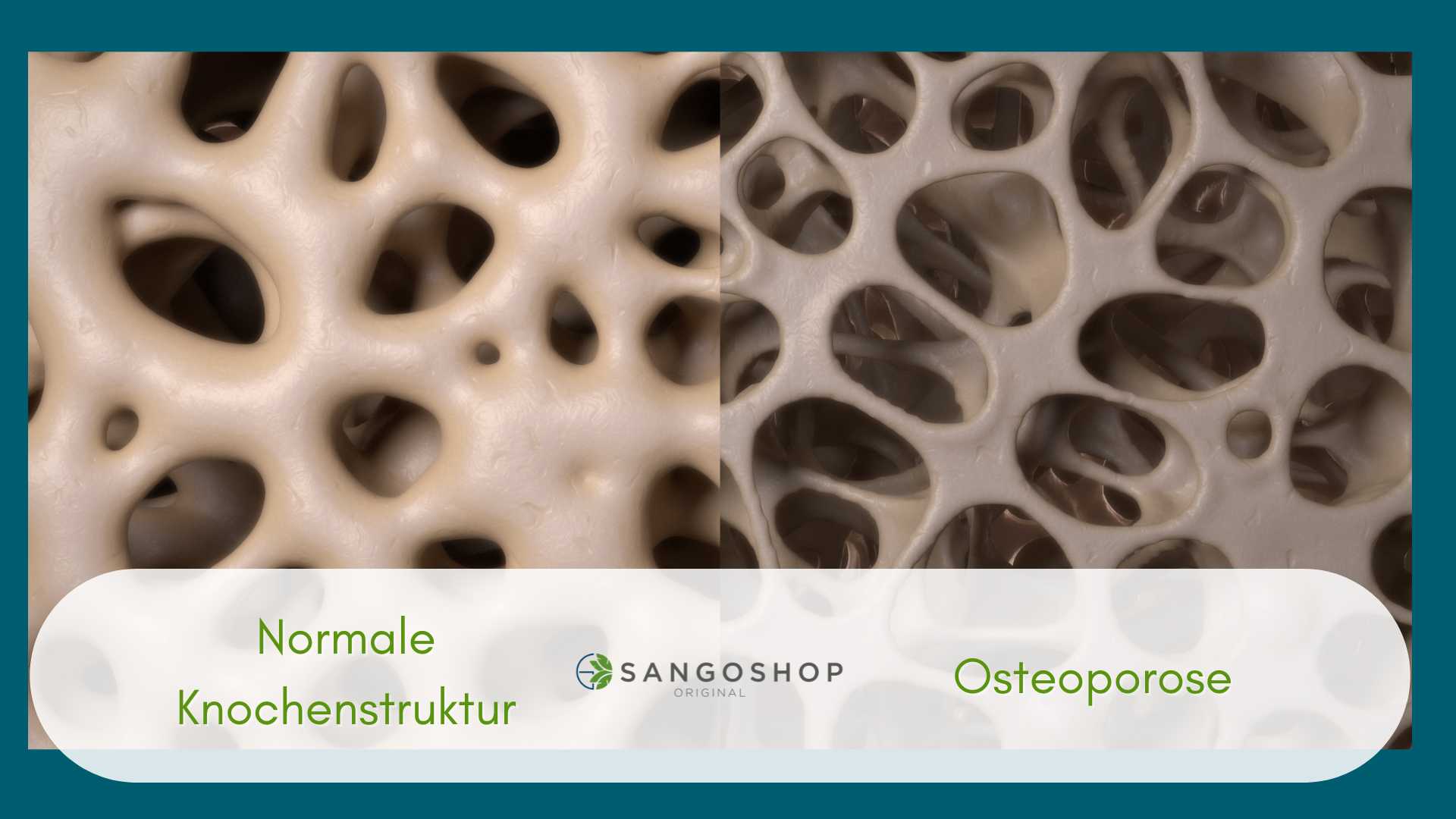 Schaubild-Osteoporose-sangoshop